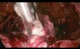 Ciąża pozamaciczna zlokalizowana w szyjce macicy - postępowanie laparoskopowe