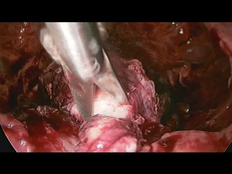 Ciąża pozamaciczna zlokalizowana w szyjce macicy - postępowanie laparoskopowe