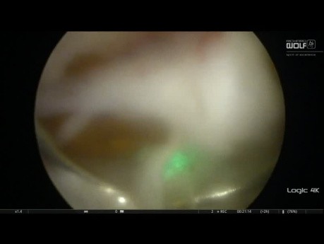Enukleacja prostaty laserem thulowym (ThuLEP)