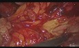 Laparoskopowa pankreatektomia dystalna z powodu nietypowej zmiany przerzutowej trzustki