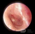 Drobna perforacja w ostrym zapaleniu ucha środkowego
