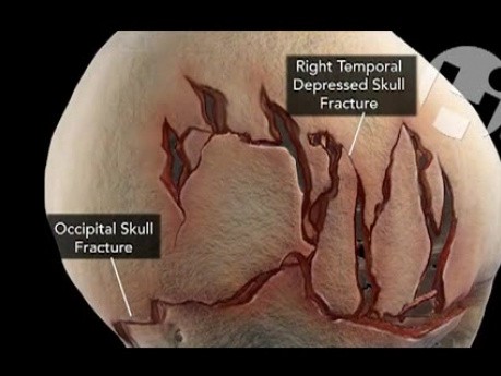 Urazy czaszki - 3