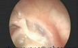 Niedodma ucha środkowego z erozją kowadełka i strzemiączka