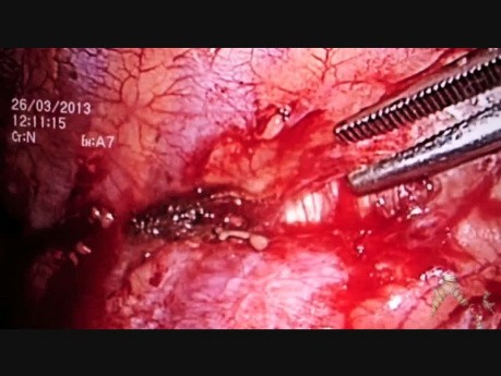 Wideotorakoskopowa pleurektomia oraz resekcja klinowa fragmentu płata górnego płuca lewego.