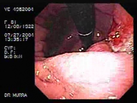Wrzodziejący gruczolakorak kąta żołądka - endoskopia
