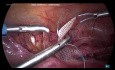 Histeropeksja laparoskopowa z powodu wypadania kompartmentu centralnego