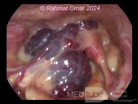 Naczyniak krtani u dorosłego pacjenta