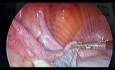 Laparoskopowa operacja niedrożności lewego jajowodu