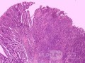 Gruczolakorak okolicy przedoddźwiernikowej i wcięcia kątowego żołądka (10 z 12)
