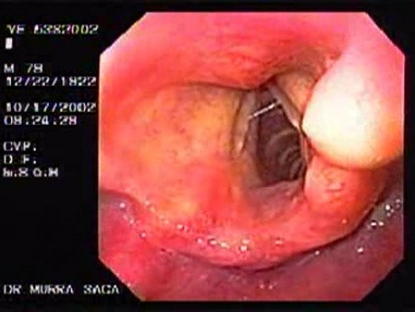 Tłuszczak ustnej części gardła