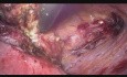 Głęboko naciekająca endometrioza ściany pęcherza moczowego