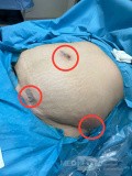 Rękawowa resekcja żołądka przez podbrzusze