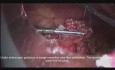 Laparoskopowo- endoskopowa resekcja guza żołądka