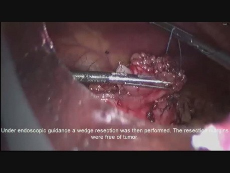 Laparoskopowo- endoskopowa resekcja guza żołądka