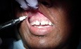 Prawie bezbolesne znieczulenie zębów przednich szczęki: część 2