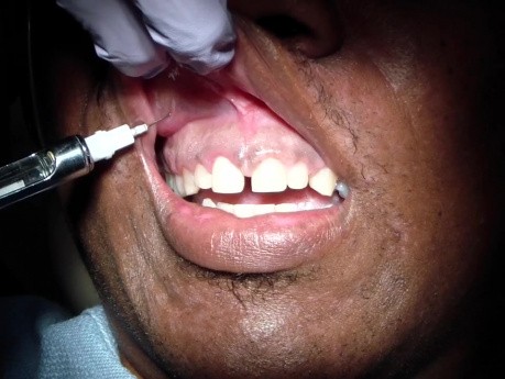 Prawie bezbolesne znieczulenie zębów przednich szczęki: część 2