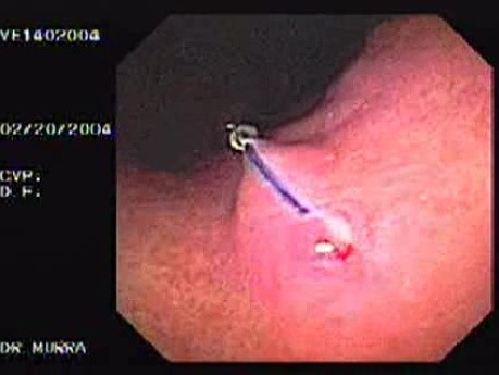 Endoskopowe szycie wewnątrz światła - guzek z reakcją na ciało obce