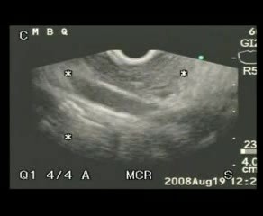 Wewnątrzprzewodowy brodawkowo-śluzowy nowotwór trzustki (IPMT II) - endoultrasonografia (EUS) z biopsją cienkoigłową