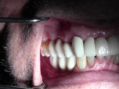 Rekonstrukcja implantami zębów #3-5, 7-10, 12-14, 28-30 - końcowa odbudowa