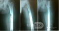 Kostniak kostnawy z zagrażającym złamaniem kości udowej