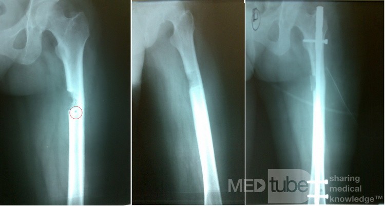 Kostniak kostnawy z zagrażającym złamaniem kości udowej