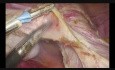 Całkowita laparoskopowa histerektomia przy użyciu nożyczek bipolarnych