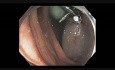 Kolonoskopia: zamykanie ubytków po endoskopowej resekcji śluzówkowej 5