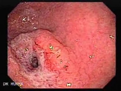 Rak gruczołowy jamy przedodźwiernikowej (2 z 3)