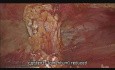 e-TEP Mesh Repair for Umbilical Hernia