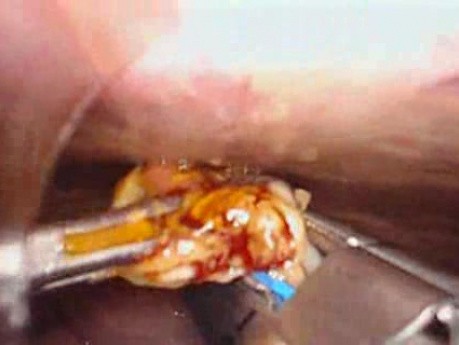 Perforacja okrężnicy z zapaleniem otrzewnej - laparoskopia (6 z 46)