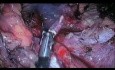 Laparo-endoskopowa jednomiejscowa (LESS) adrenalektomia z powodu gruczolaka