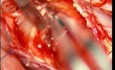 Mikrochirurgiczne usunięcie wewnątrzrdzeniowego guza zlokalizowanego w odcinku szyjnym rdzenia kręgowego - przypadek 2