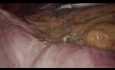 Hemikolektomia prawostronna z zespoleniem metodą laparoskopową