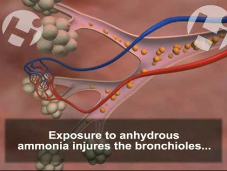 Amoniak bezwodny - uszkodzenia ciała