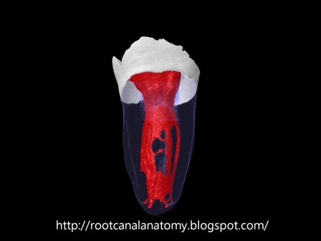 Drugi ząb trzonowy żuchwy - kanał typu C
