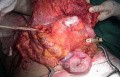 Przerzuty raka nerki do okrężnicy wstępującej (6 z 11)