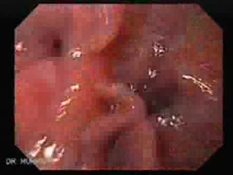 Rak włóknisty żołądka - endoskopia (47 z 47)