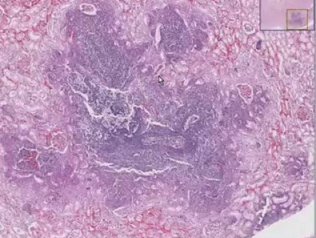 Ropień z powodu infekcji Pseudomonas