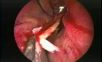 Endoskopowa plastyka przegrody nosa