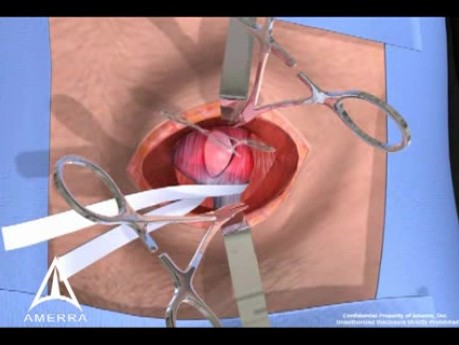 Przepuklina pachwinowa - procedura otwarta - animacja 3D
