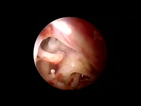Otoskleroza - endoskopowa stapedotomia