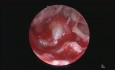 Perlak mezotympanalny - zabieg endoskopowy