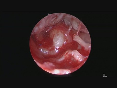 Perlak mezotympanalny - zabieg endoskopowy