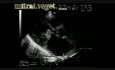 Infekcyjne zapalenie wsierdzia: wegetacje na obu płatkach zastawki mitralnej obejmujące płatki zastawki aortalnej