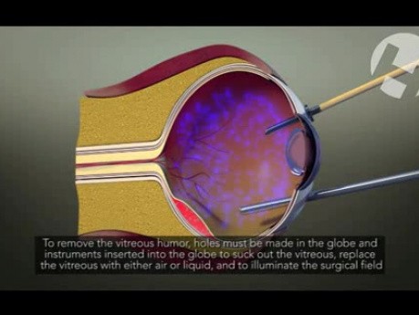 Witrektomia - zabieg wycięcia ciała szklistego z wnętrza gałki ocznej