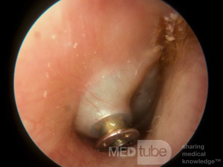 Ostre zapalenie ucha środkowego z wypychaniem rurki wentylacyjnej