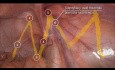 Kluczowe etapy operacji TAPP/TEP wg protokołu Critical View of Myopectineal Orifice