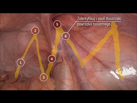 Kluczowe etapy operacji TAPP/TEP wg protokołu Critical View of Myopectineal Orifice