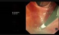 Endoskopowa cholangiopankreatografia wsteczna (ECPW) u pacjentki po częściowej resekcji żołądka Billroth II