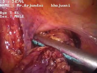 Resekcja jelita grubego - operacja laparoskopowa